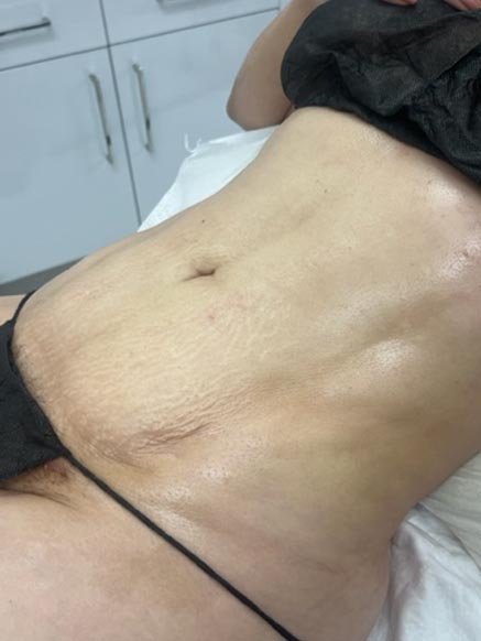 Lymphatic Drainage Massage real patient case photo