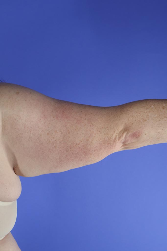 Arm Liposuction real patient case photo