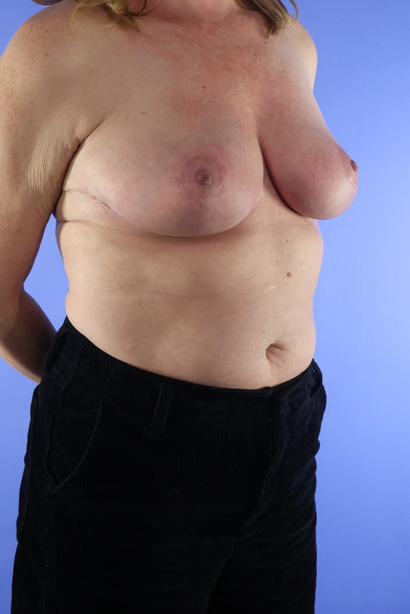 Breast Lift real patient case photo