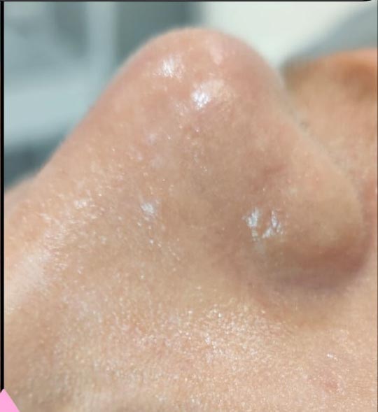 Hydrafacial real patient case photo