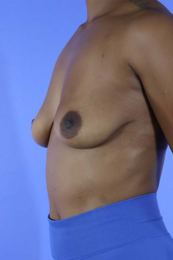 Breast Implant Removal real patient case photo