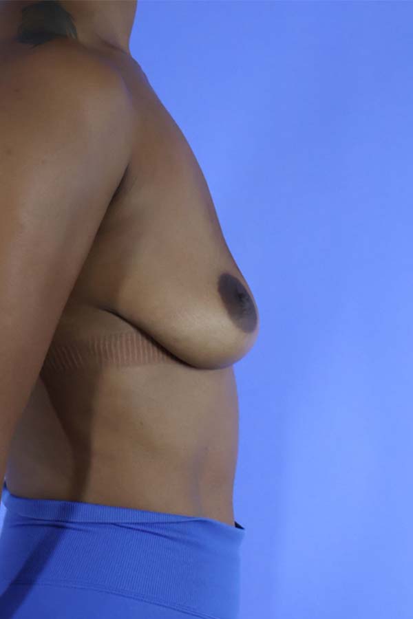 Breast Implant Removal real patient case photo