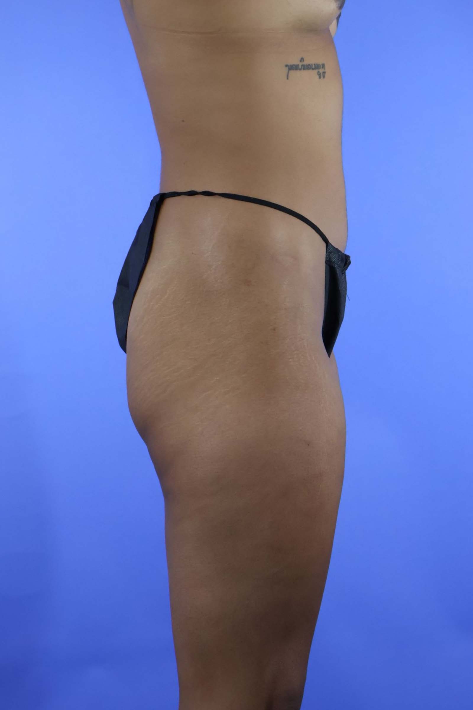 Tummy Tuck real patient case photo