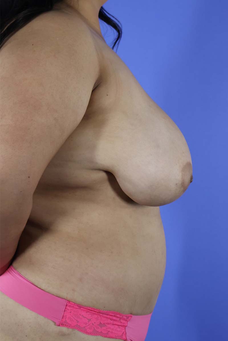 Breast Lift real patient case photo