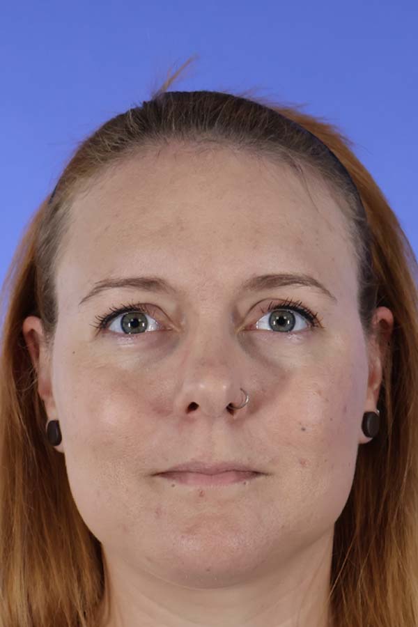 Hairline Lowering real patient case photo