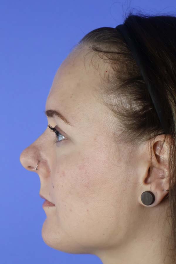 Hairline Lowering real patient case photo