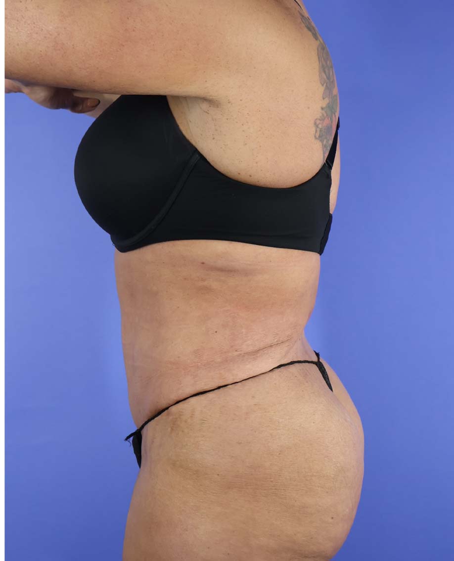 After Weight Loss Surgery real patient case photo