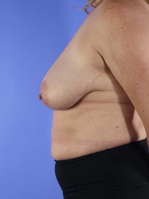 Breast Reduction real patient case photo