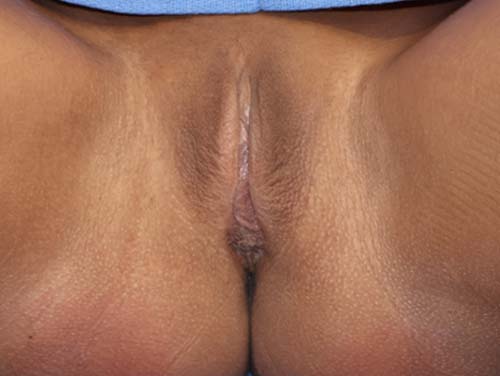Labiaplasty real patient case photo