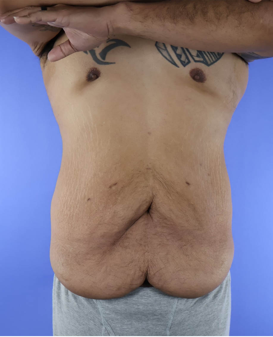 After Weight Loss Surgery real patient case photo