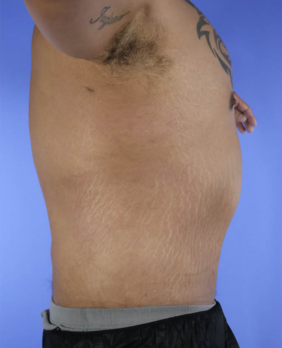 After Weight Loss Surgery real patient case photo