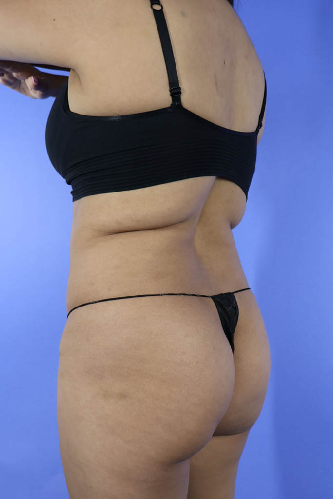 Liposuction real patient case photo Liposuction real patient case photo