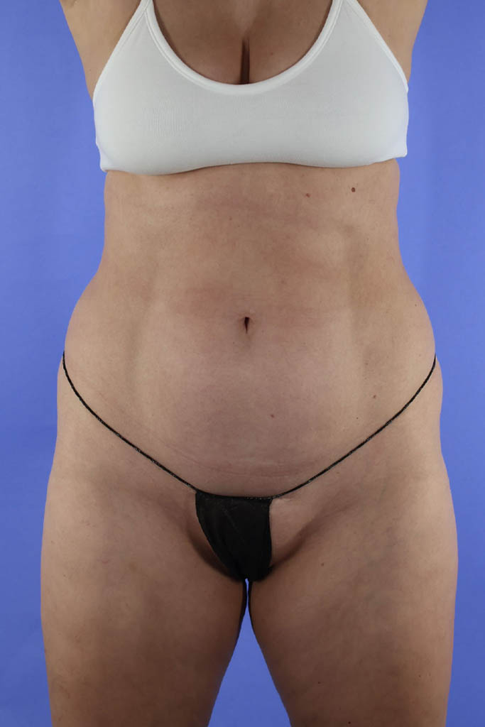Brazilian Butt Lift real patient case photo Brazilian Butt Lift real patient case photo