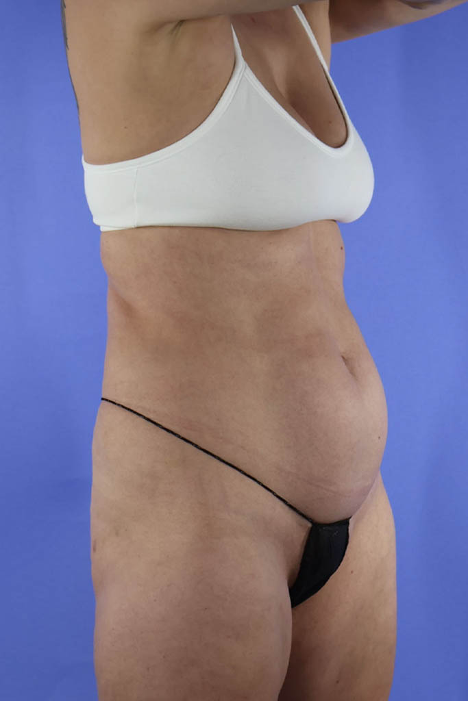 Liposuction real patient case photo Liposuction real patient case photo