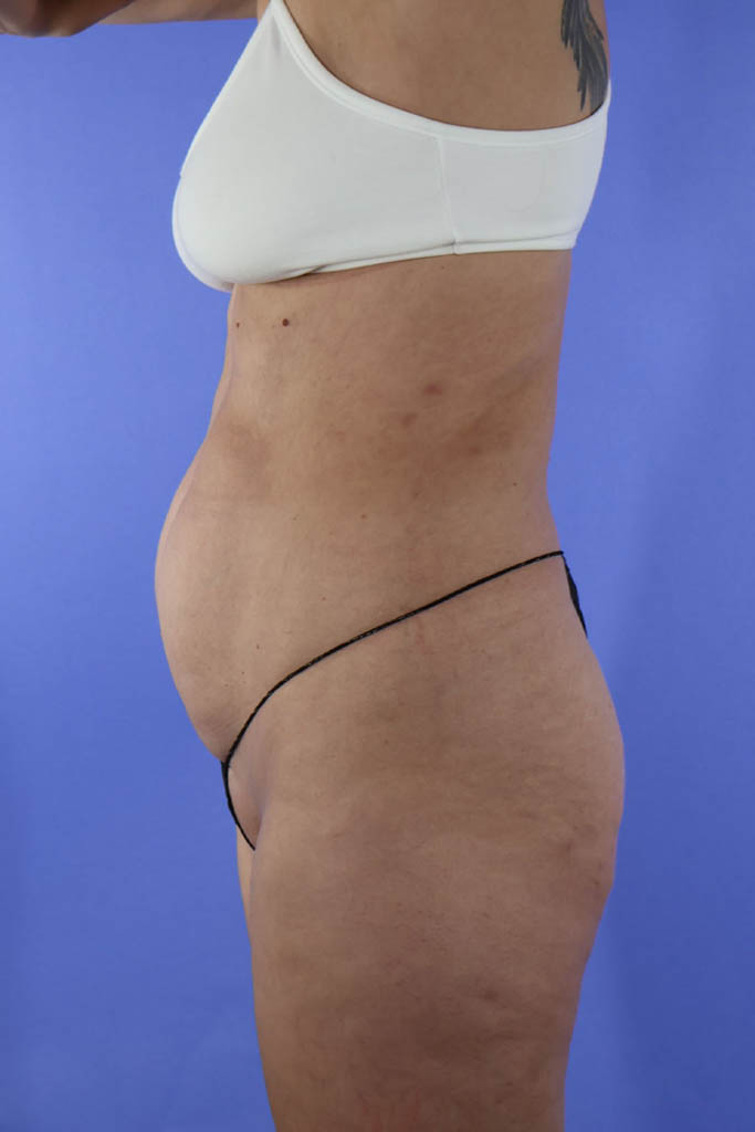 Liposuction real patient case photo Liposuction real patient case photo