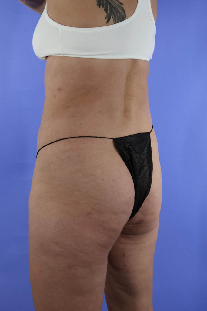 Liposuction real patient case photo Liposuction real patient case photo