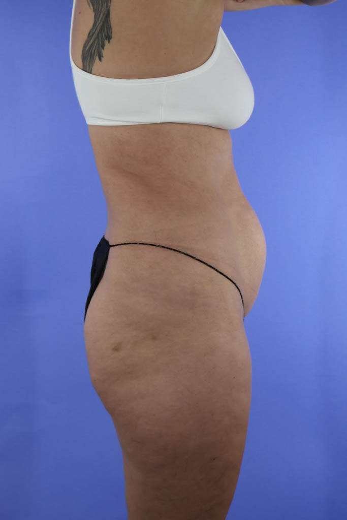Brazilian Butt Lift real patient case photo Brazilian Butt Lift real patient case photo