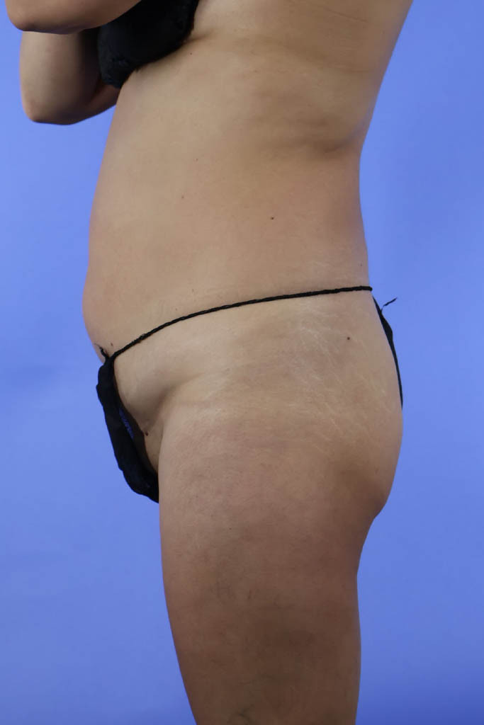 Liposuction real patient case photo Liposuction real patient case photo