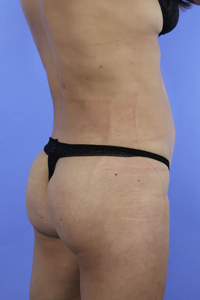 Brazilian Butt Lift real patient case photo Brazilian Butt Lift real patient case photo
