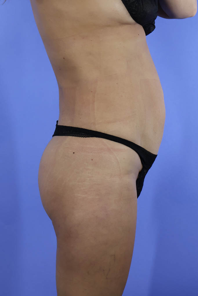 Liposuction real patient case photo Liposuction real patient case photo