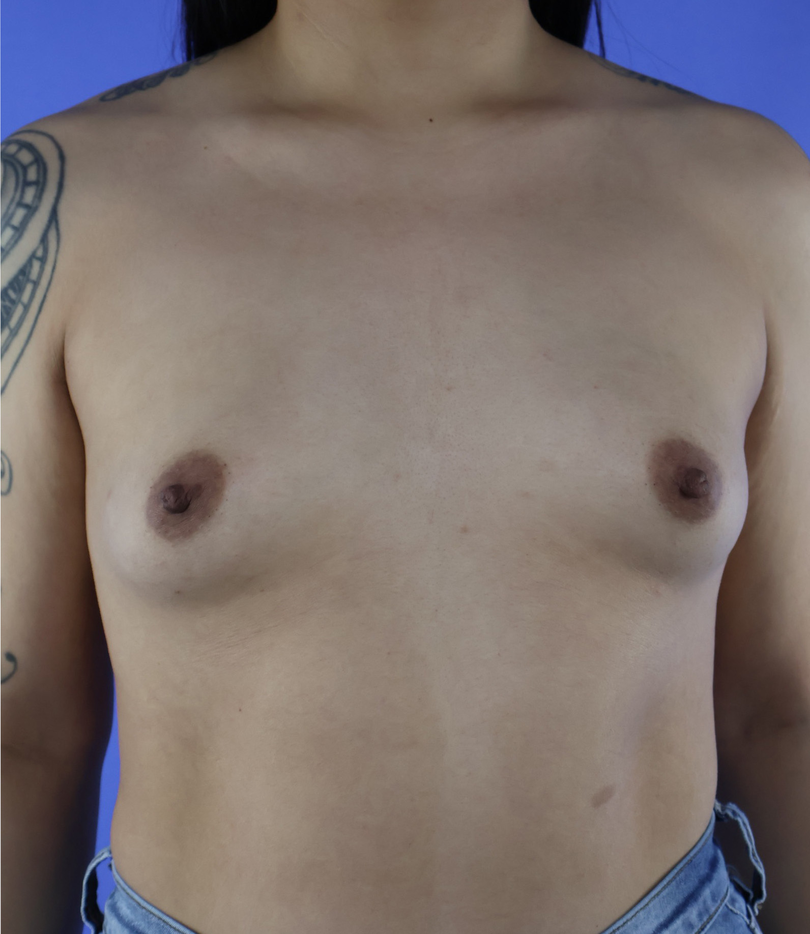 Breast Augmentation real patient case photo Breast Augmentation real patient case photo
