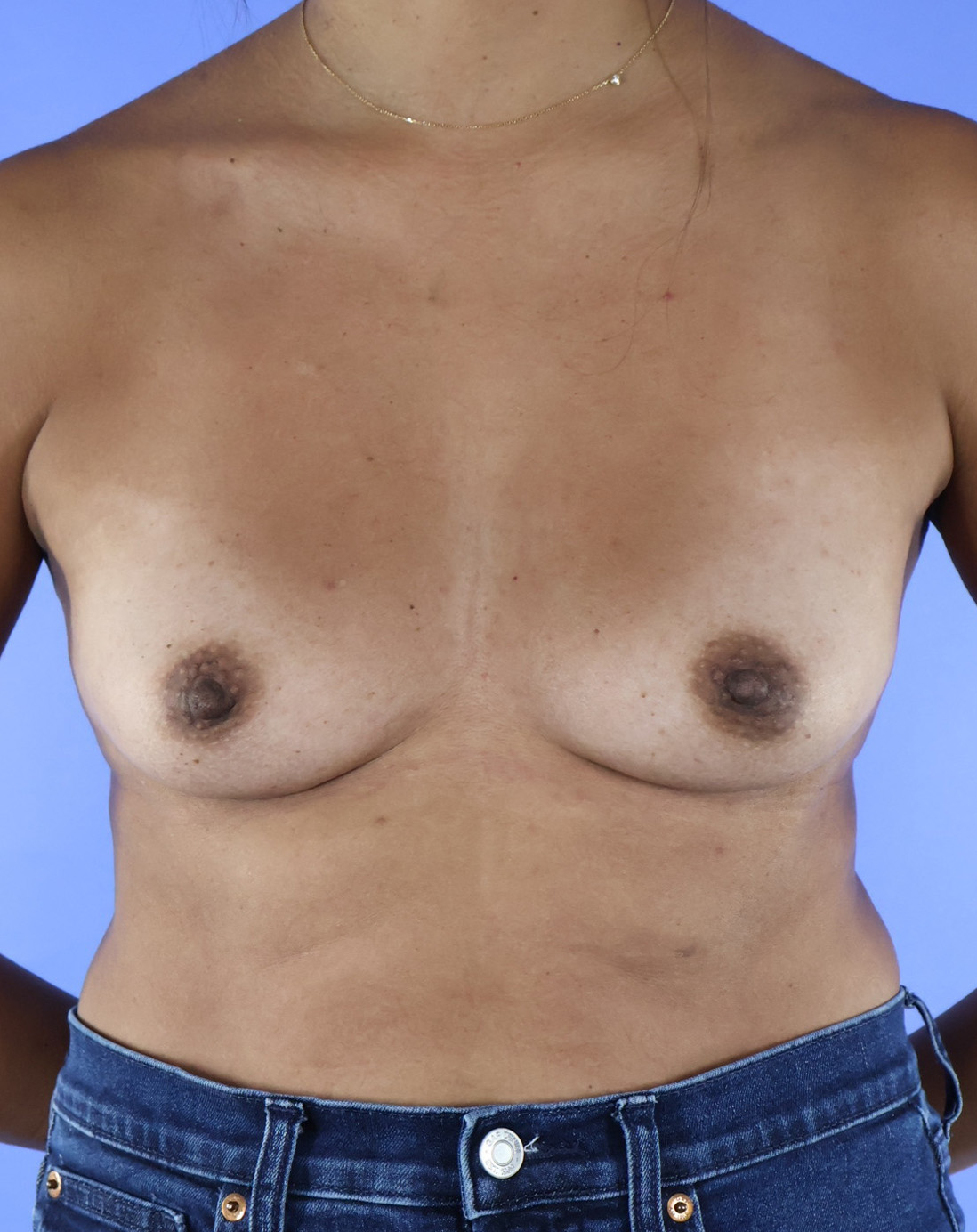 Breast Augmentation real patient case photo Breast Augmentation real patient case photo