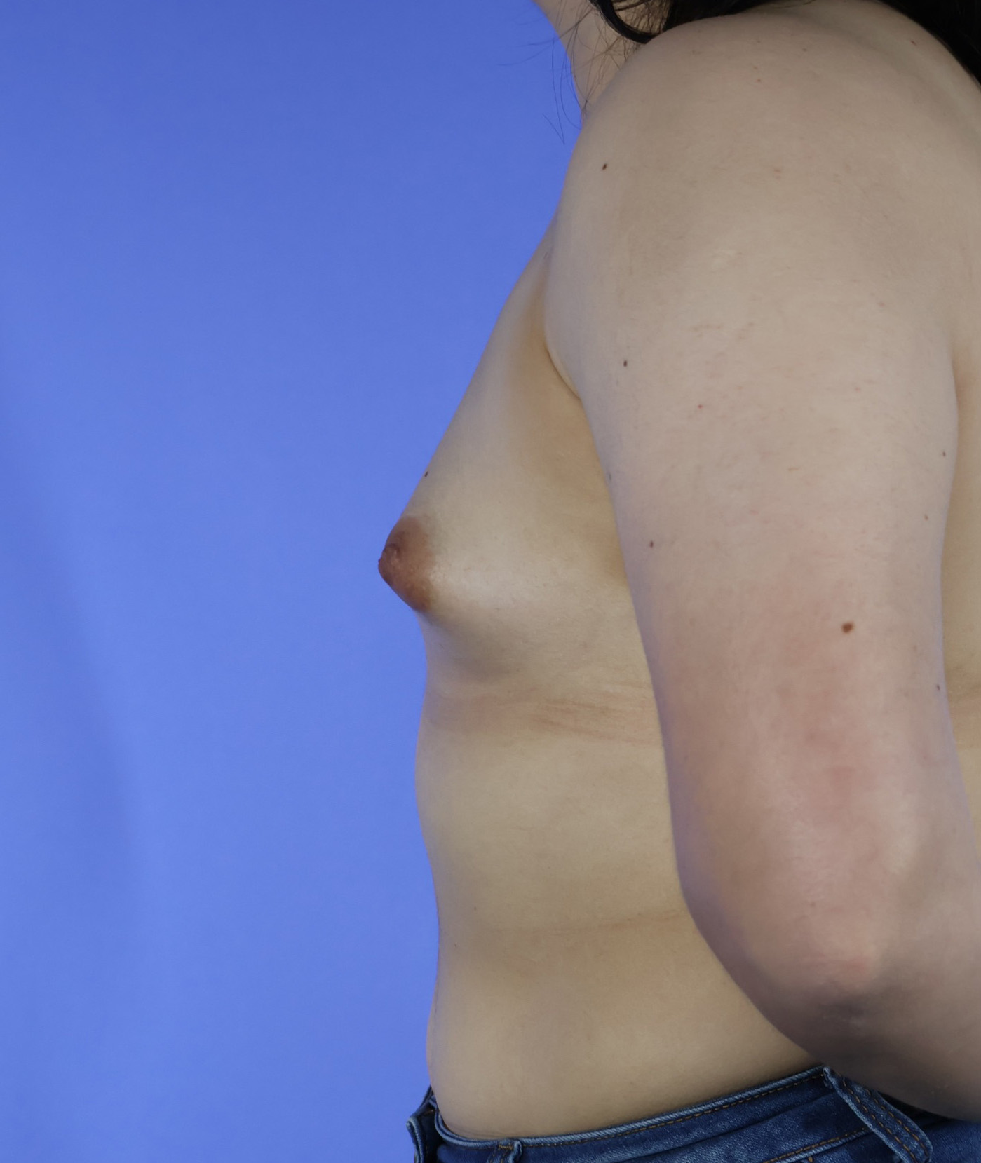 Breast Augmentation real patient case photo Breast Augmentation real patient case photo