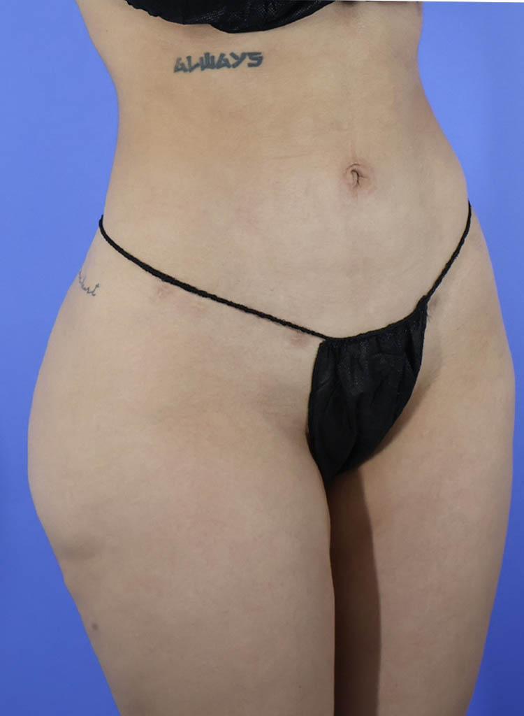 Liposuction real patient case photo Liposuction real patient case photo