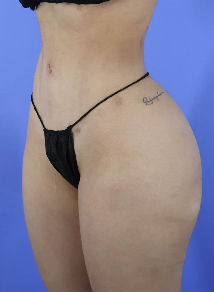 Liposuction real patient case photo Liposuction real patient case photo