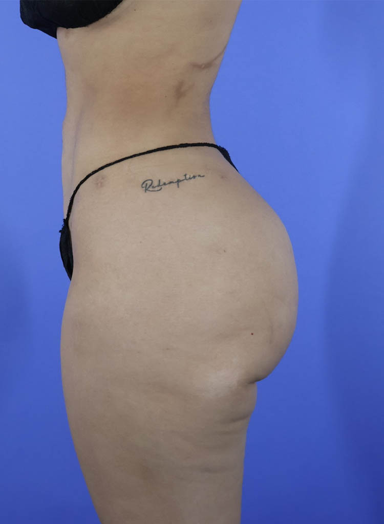 Liposuction real patient case photo Liposuction real patient case photo