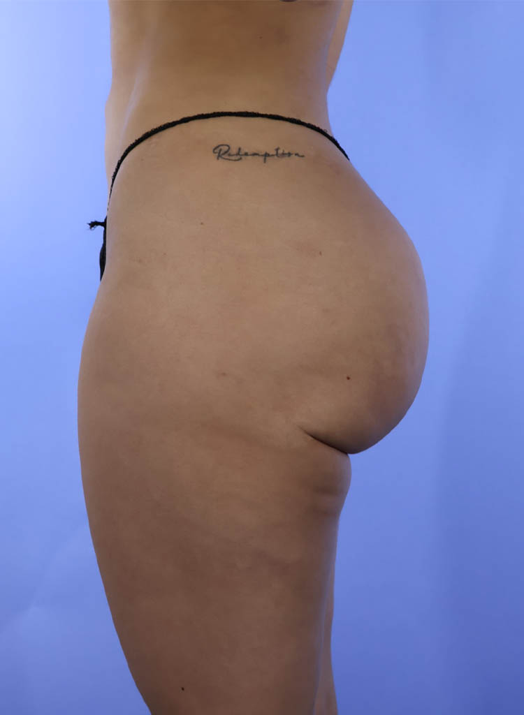 Liposuction real patient case photo Liposuction real patient case photo