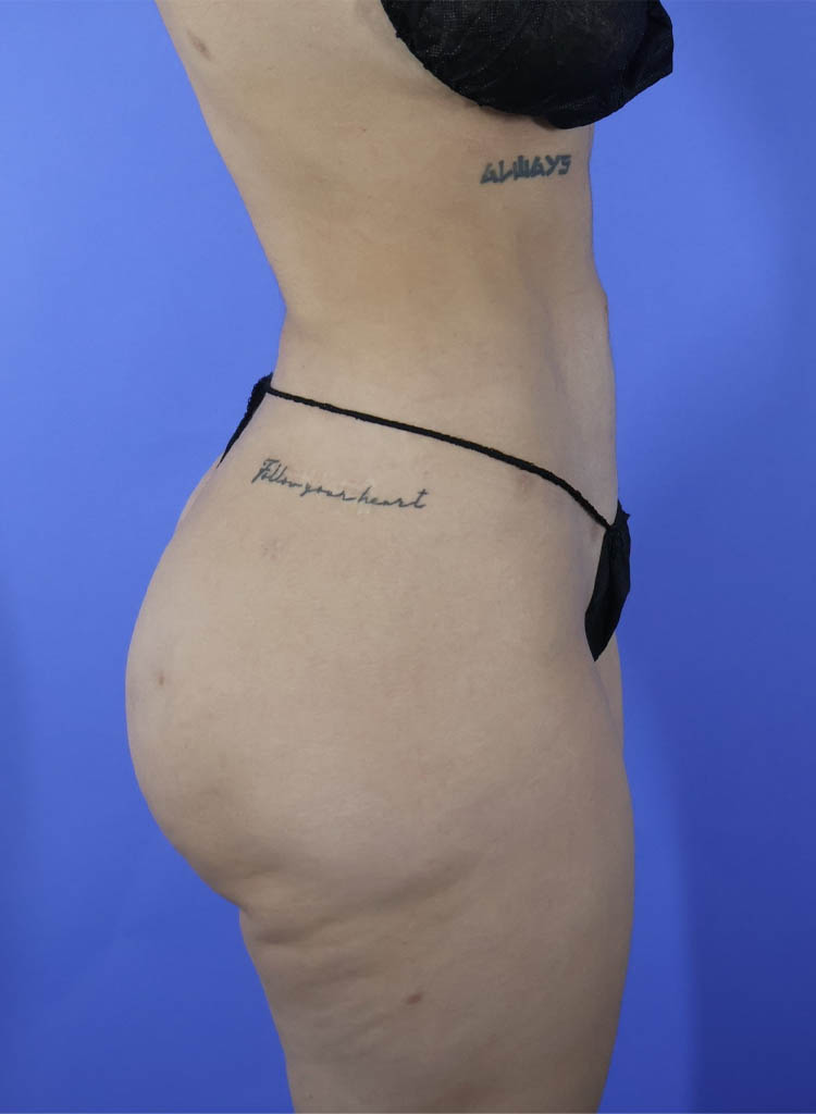 Liposuction real patient case photo Liposuction real patient case photo