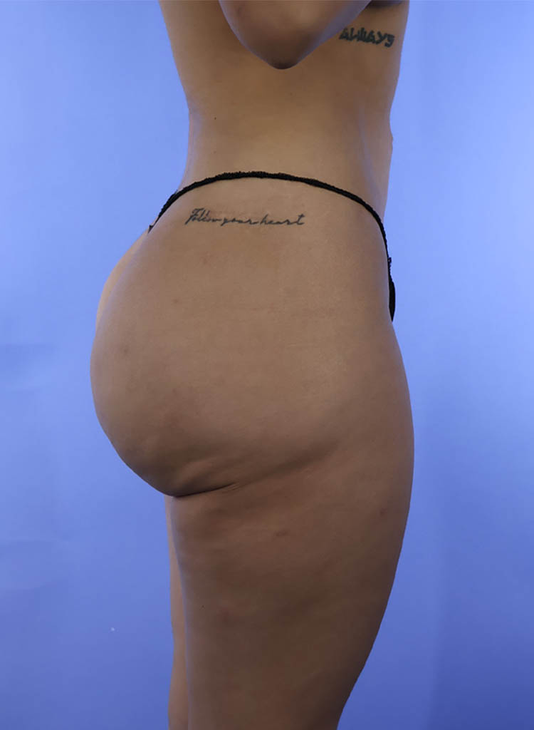 Liposuction real patient case photo Liposuction real patient case photo