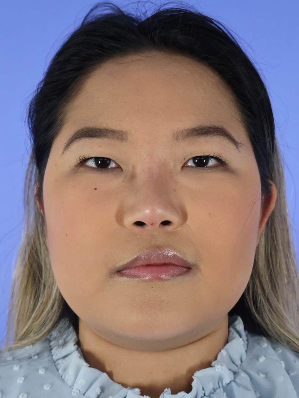 Buccal Fat Removal and V Line real patient case photo Buccal Fat Removal and V Line real patient case photo