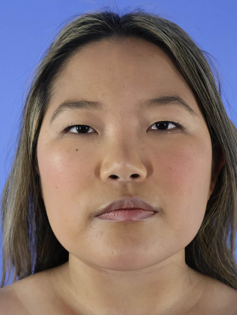 Buccal Fat Removal and V Line real patient case photo Buccal Fat Removal and V Line real patient case photo