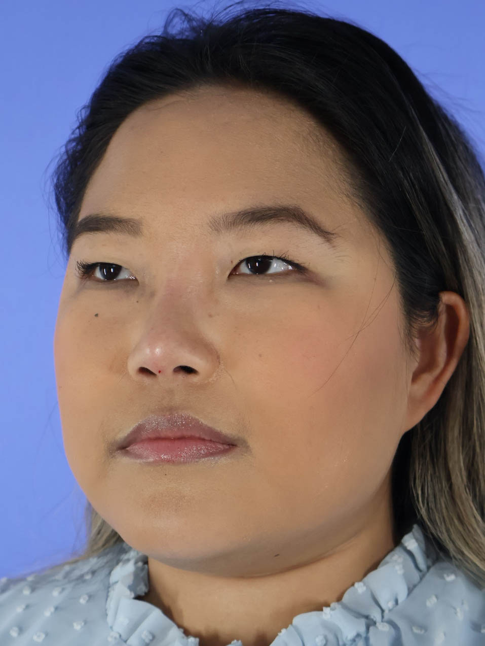 Buccal Fat Removal and V Line real patient case photo Buccal Fat Removal and V Line real patient case photo