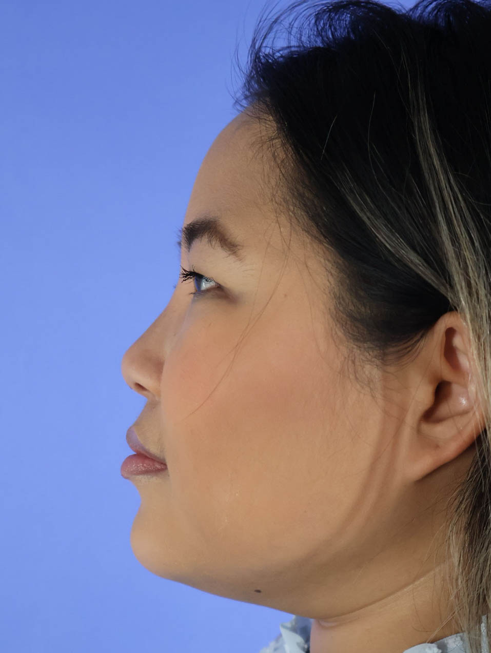 Chin Liposuction real patient case photo Chin Liposuction real patient case photo
