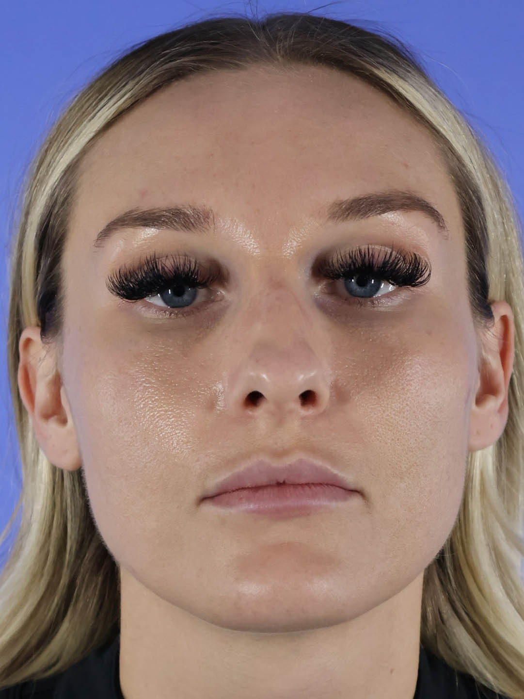 Revision Rhinoplasty real patient case photo Revision Rhinoplasty real patient case photo