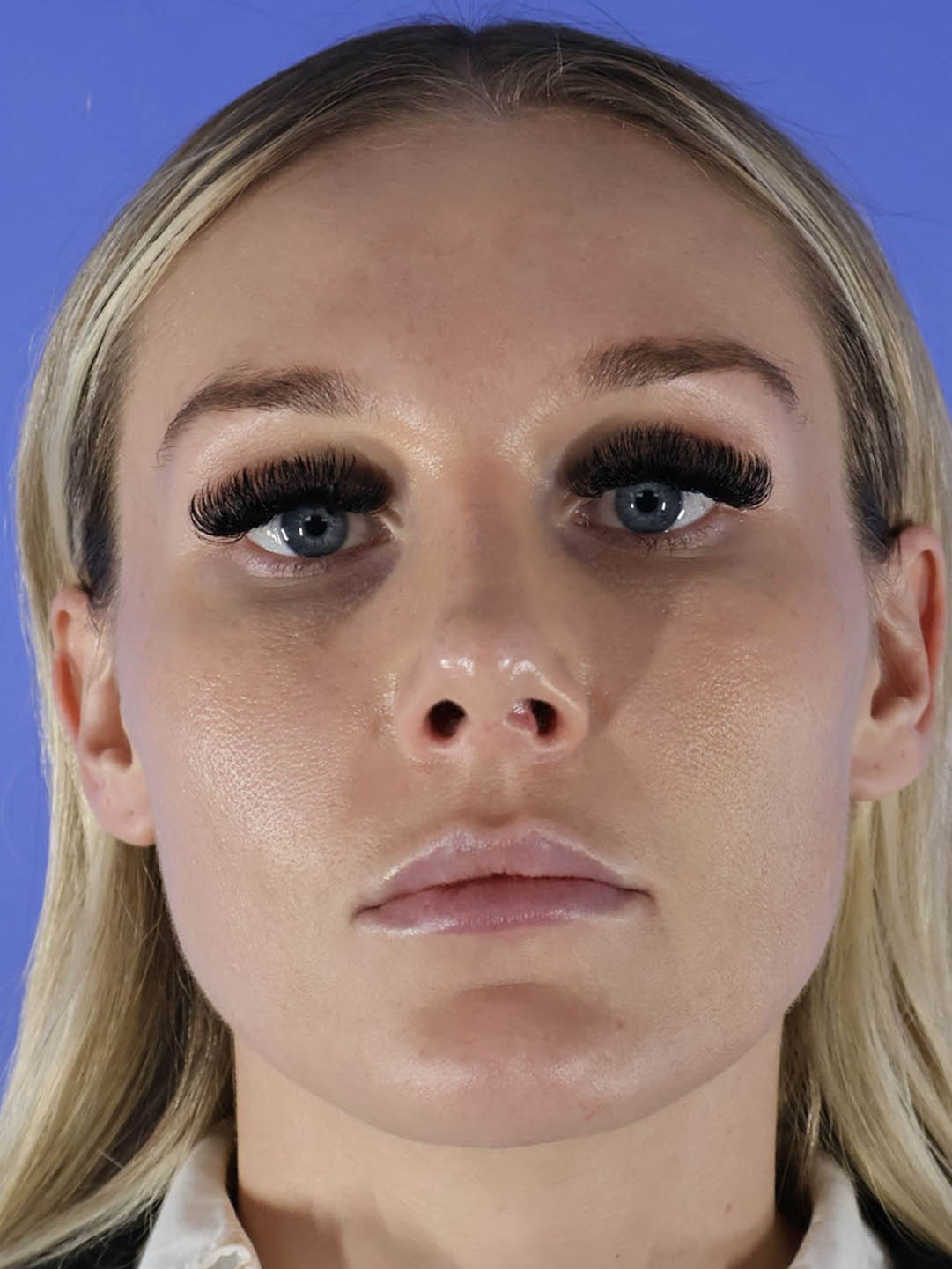 Revision Rhinoplasty real patient case photo Revision Rhinoplasty real patient case photo