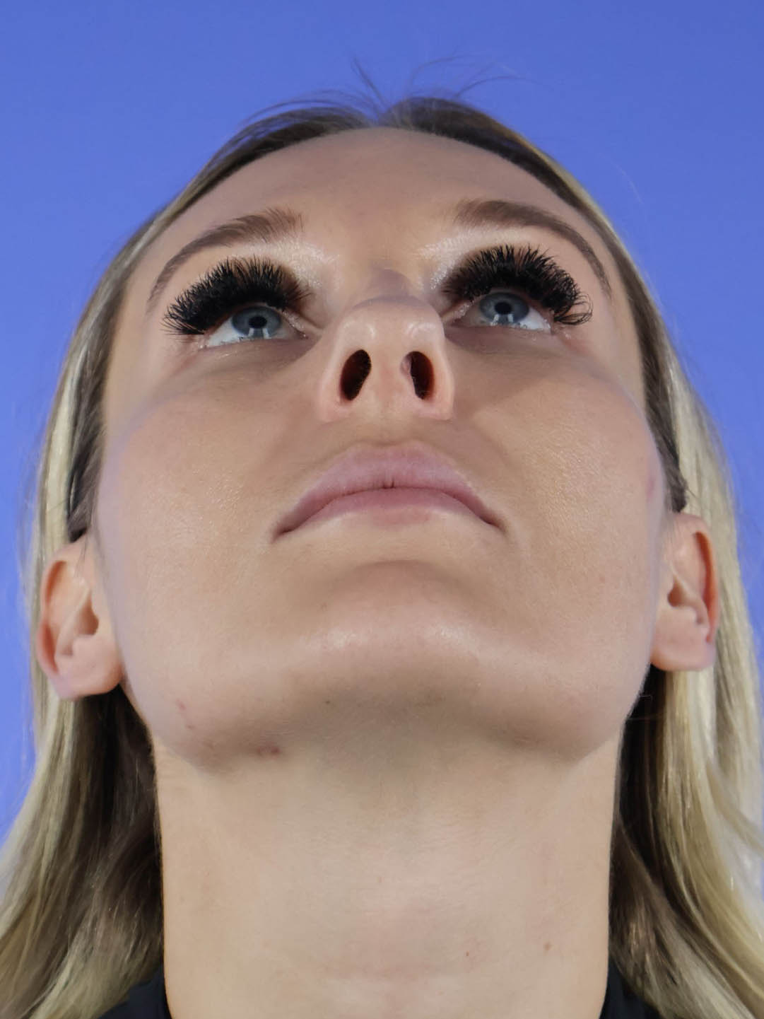 Revision Rhinoplasty real patient case photo Revision Rhinoplasty real patient case photo