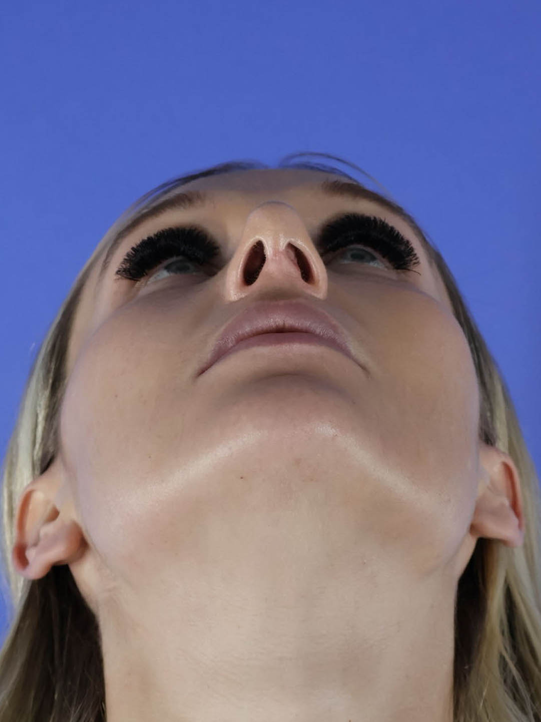 Revision Rhinoplasty real patient case photo Revision Rhinoplasty real patient case photo