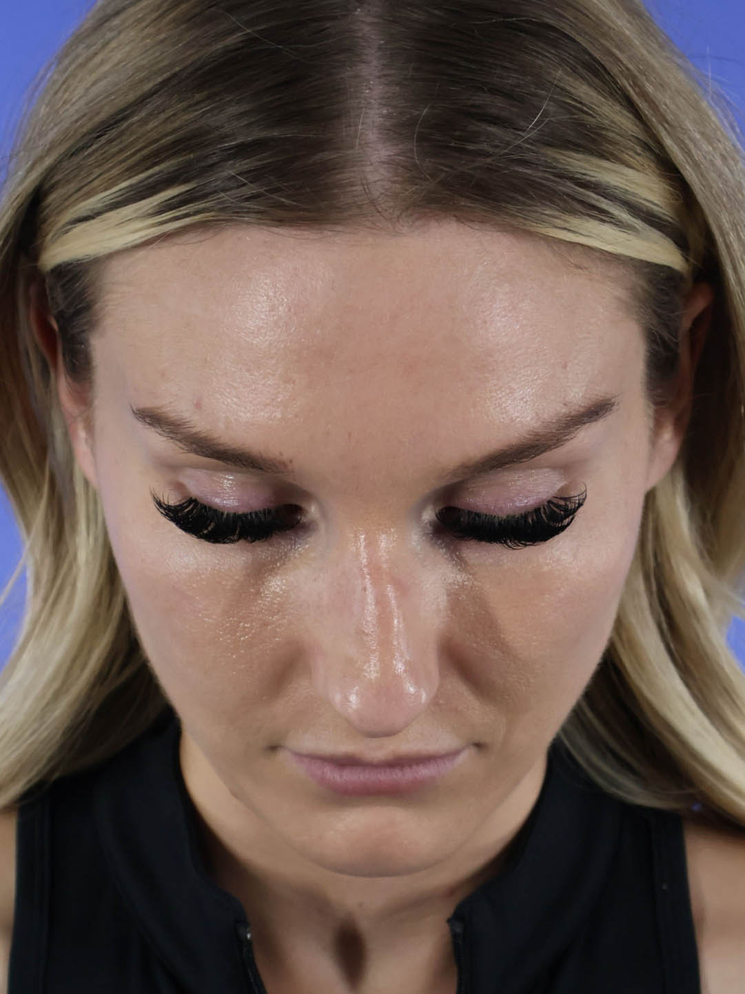 Revision Rhinoplasty real patient case photo Revision Rhinoplasty real patient case photo