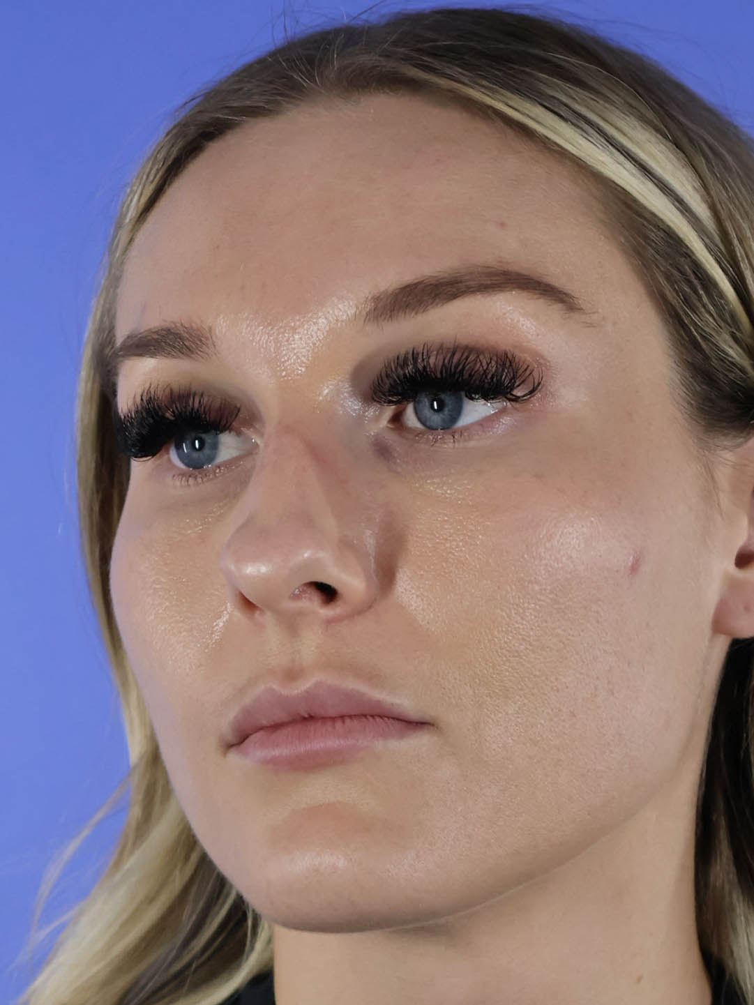 Revision Rhinoplasty real patient case photo Revision Rhinoplasty real patient case photo