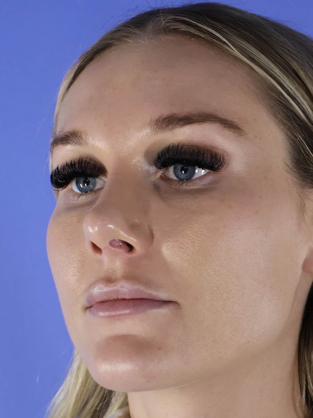 Revision Rhinoplasty real patient case photo Revision Rhinoplasty real patient case photo