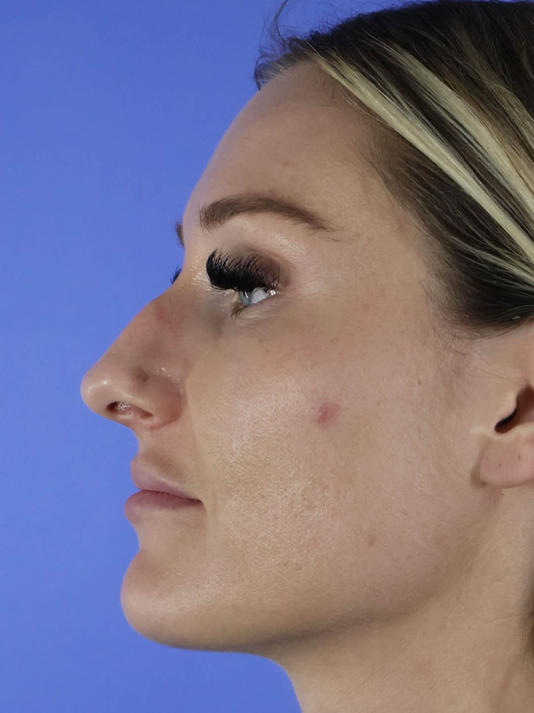 Revision Rhinoplasty real patient case photo Revision Rhinoplasty real patient case photo