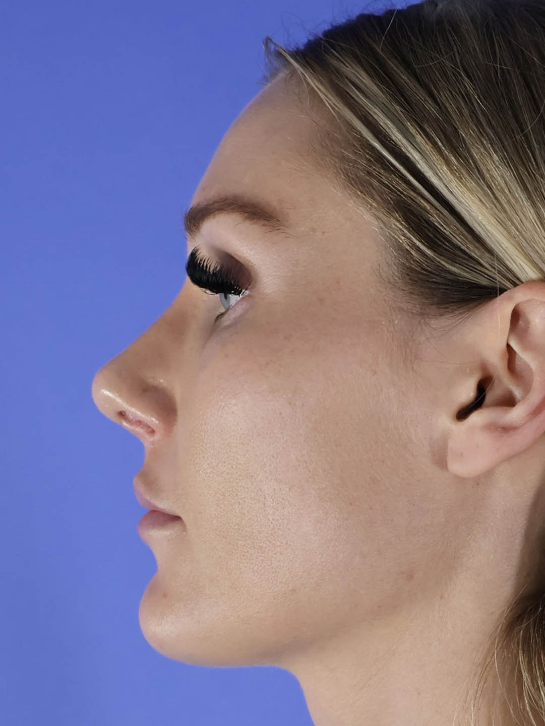Revision Rhinoplasty real patient case photo Revision Rhinoplasty real patient case photo