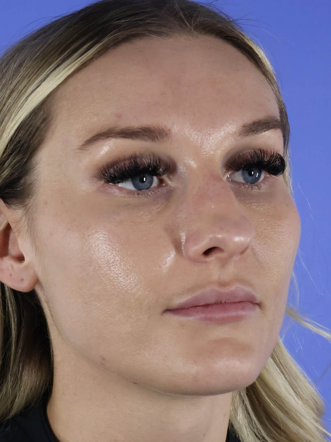 Revision Rhinoplasty real patient case photo Revision Rhinoplasty real patient case photo