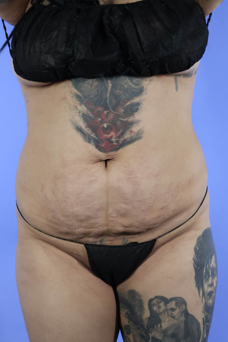 Tummy Tuck real patient case photo Tummy Tuck real patient case photo