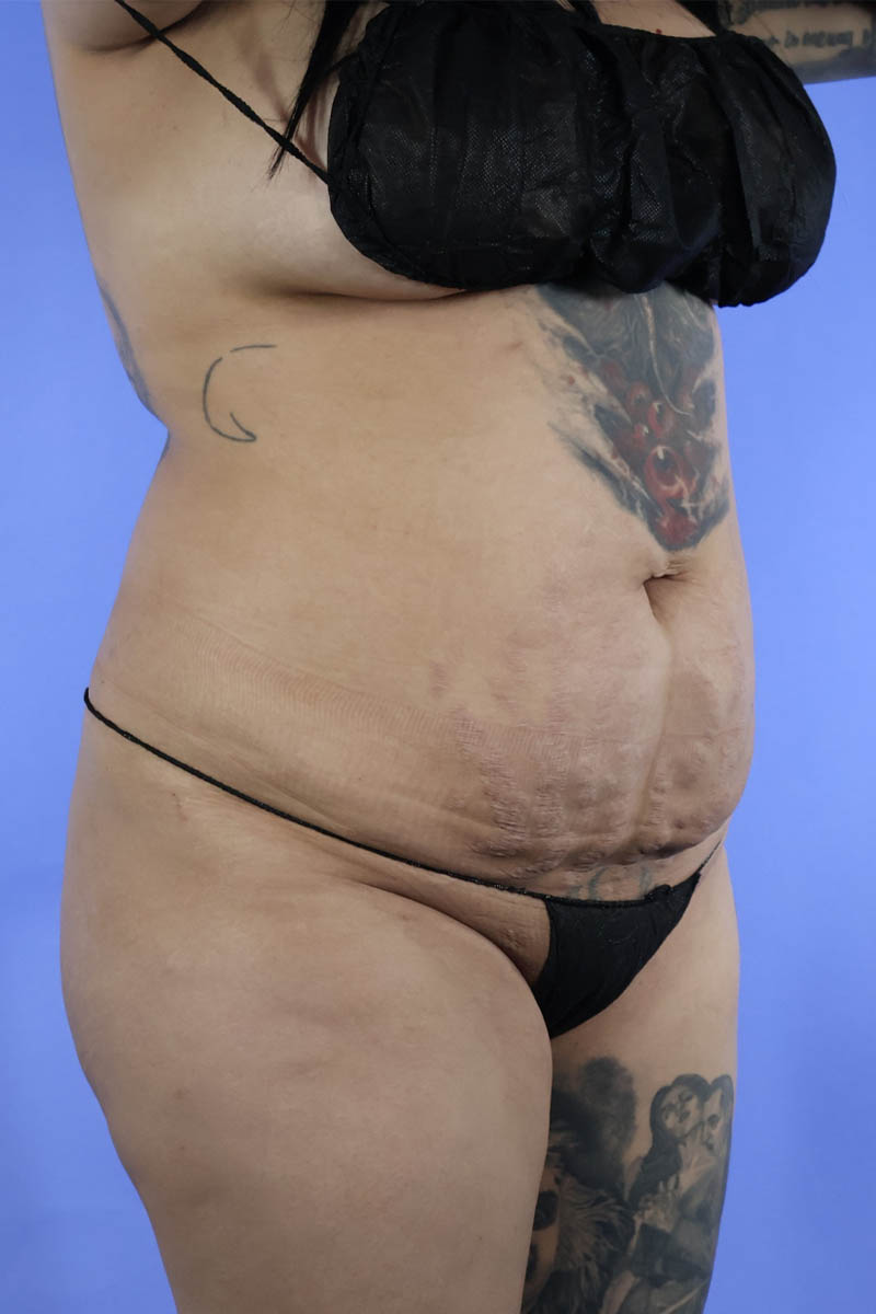 Tummy Tuck real patient case photo Tummy Tuck real patient case photo