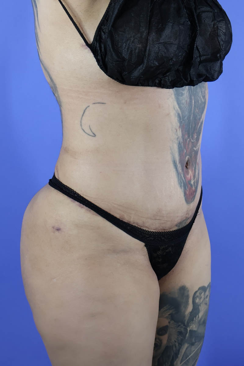 Tummy Tuck real patient case photo Tummy Tuck real patient case photo
